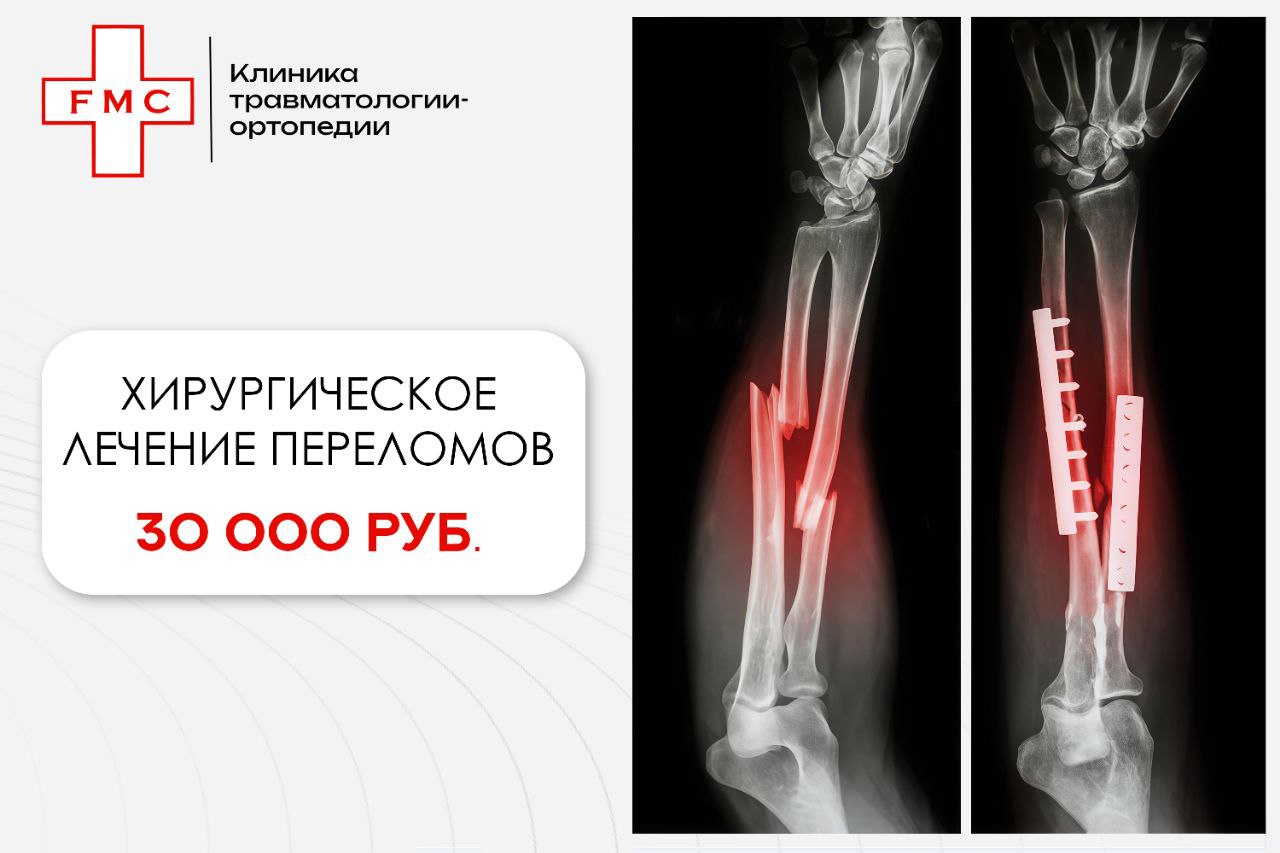 Хирургическое лечение переломов